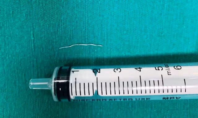 Gắp sợi kim loại trong cổ bệnh nhi 8 tháng tuổi