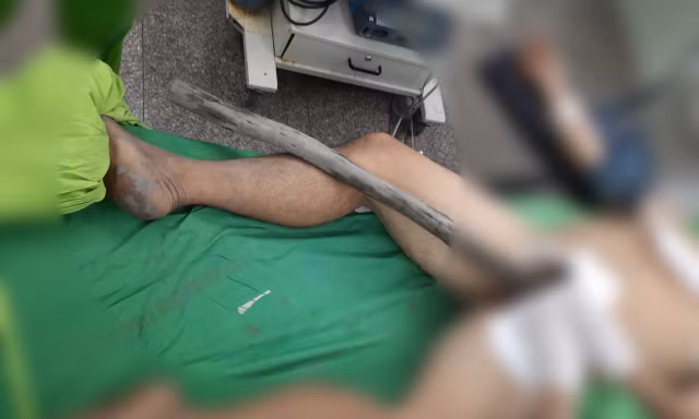 Người đàn ông mang cả cây gỗ xuyên từ tầng sinh môn đến bụng nhập viện