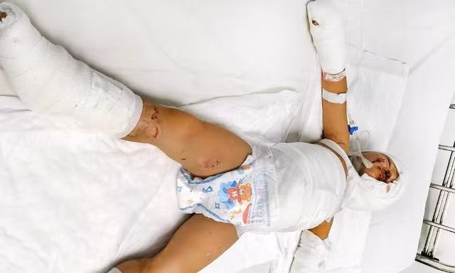 Trẻ nhập viện do phỏng xăng (ảnh: BVCC)