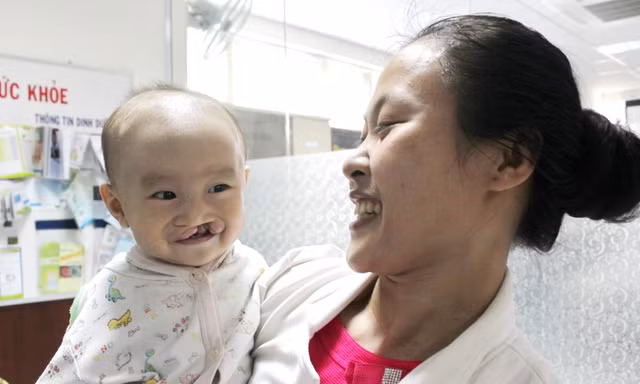 Dự kiến 300 trẻ bị khe hở môi, vòm miệng sẽ được phẫu thuật miễn phí trong tháng 10. 