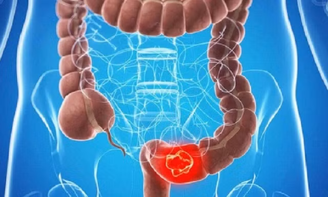 Phát hiện dấu hiệu sớm ung thư đại tràng