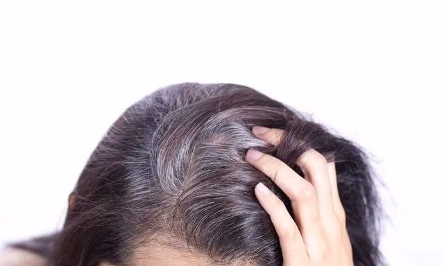 Vì sao nhiều người bị bạc tóc sớm?