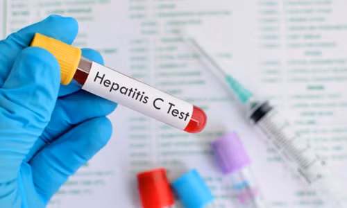 12 dấu hiệu cảnh báo bạn nhiễm virus viêm gan C