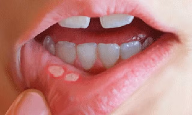 Ung thư ngỡ chỉ là nhiệt miệng, người đàn ông phải cắt cả góc má