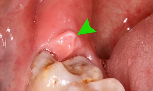 Không nhổ răng khôn vào những thời điểm sau để tránh các biến chứng về sau