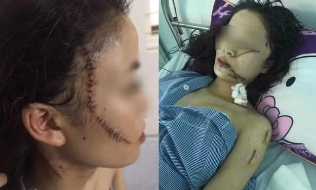 Toàn cảnh thiếu nữ 18 tuổi bị 3 cô gái đánh đập, rạch mặt giữa đêm