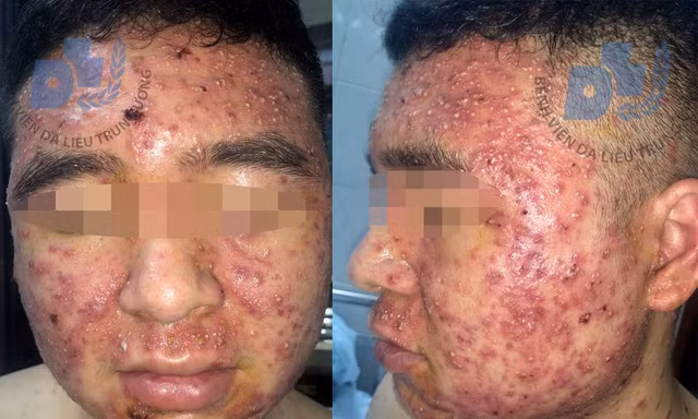 Nạn nhân của mỹ phẩm giả mua trên mạng