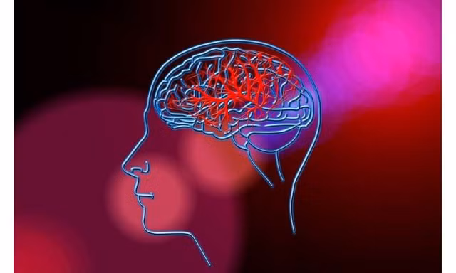 Tìm ra phương pháp mới có thể giảm nguy cơ tái phát đột quỵ 
