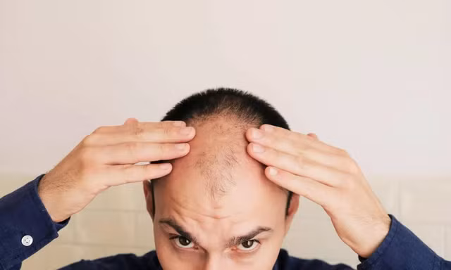 Tại sao đàn ông hay bị hói ở đỉnh đầu và cách chữa trị 