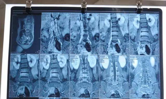 Đùa giỡn va cột sống vào cạnh bàn, bé gái suýt chết vì căn bệnh hiếm gặp