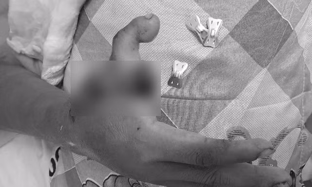 Phẫu thuật ‘dời’ ngón chân lên làm ngón tay cái cho nam bệnh nhân