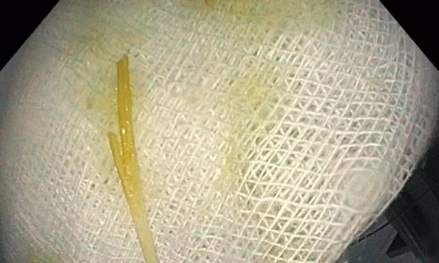 Que tăm đâm thủng tá tràng người phụ nữ