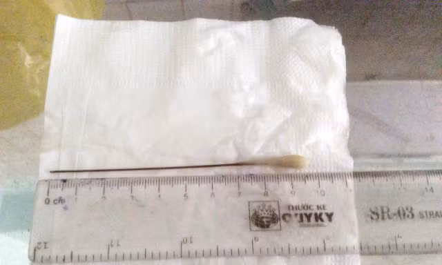 Gắp thành công tăm tre dài gần 10 cm ra khỏi phổi cụ ông