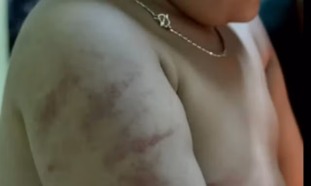 Vụ gia đình tố cô giáo đánh trẻ ở Bình Định: Phòng Giáo dục báo cáo gì?