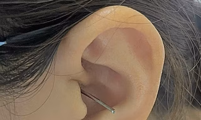 Cô gái trẻ bị cây lấy ráy tai đâm thủng màng nhĩ