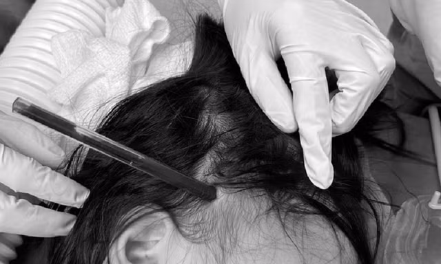 Bé gái 4 tuổi bị cây bút bi đâm xuyên hộp sọ