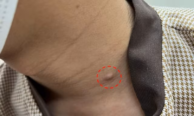 Mụn lâu lành biến thành ung thư