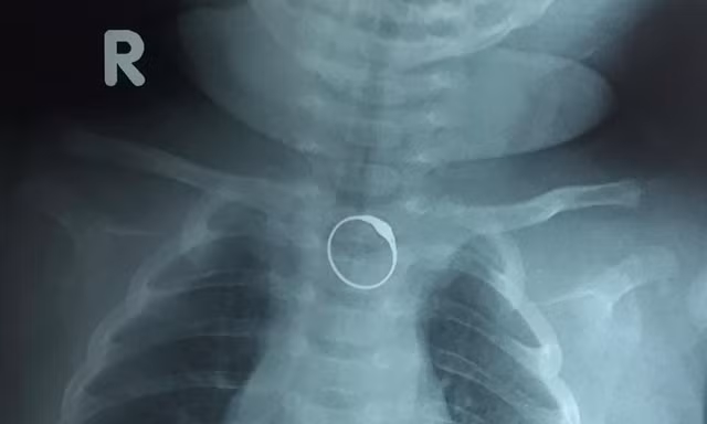 Chiếc nhẫn vàng kẹt ở thực quản bé gái 2 tháng tuổi