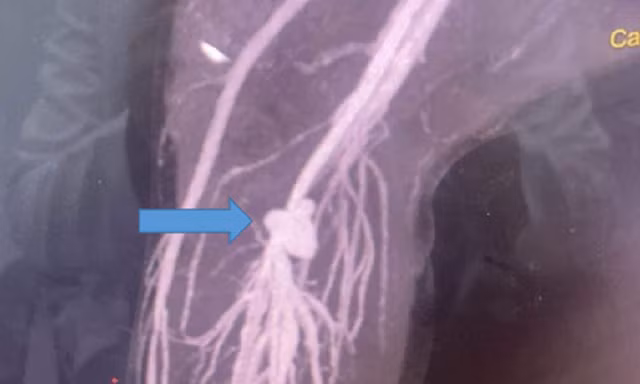 Bé trai suýt bị cắt cụt chân vì vết thương 'bé tí'