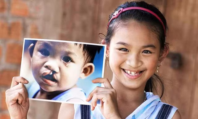 Phẫu thuật miễn phí dị tật khe hở môi, hàm ếch cho bệnh nhân