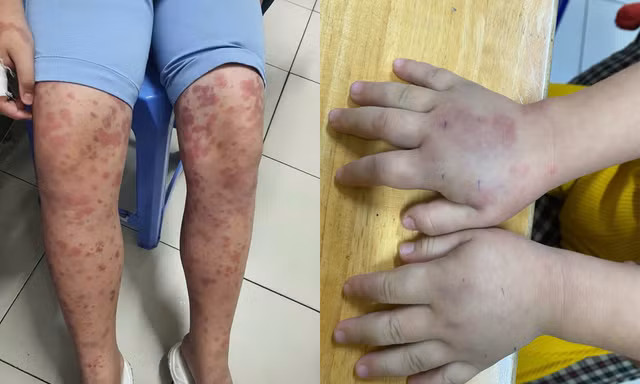 Cảnh báo biến chứng suy thận suốt đời từ viêm mạch máu ở trẻ