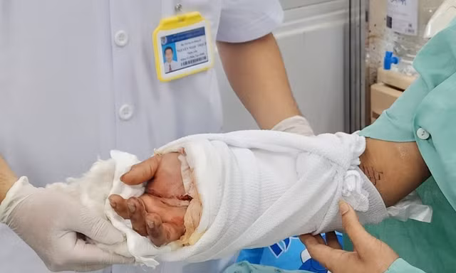 Nam thanh niên bị máy dập lìa cổ tay lúc nửa đêm