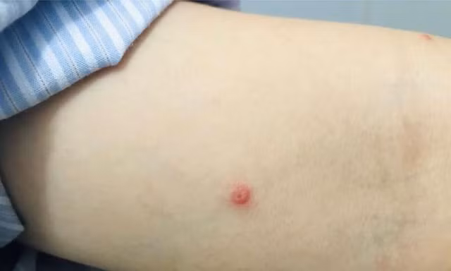 Sức khỏe ca bệnh đậu mùa khỉ đầu tiên ở Việt Nam ra sao?