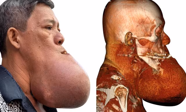 Cứu bệnh nhân bị 'nổ tung' khối u khổng lồ