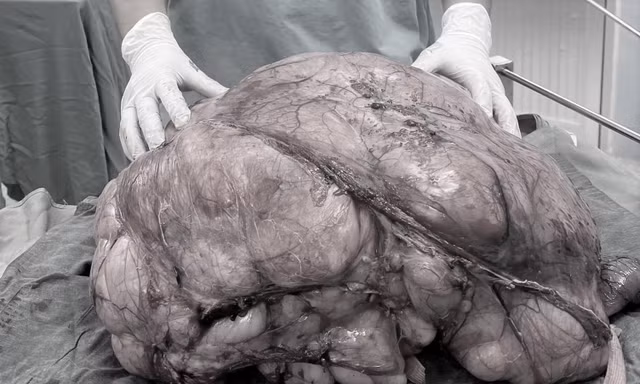 Người đàn ông ở TPHCM mang 'bụng bầu' nặng gần 18kg