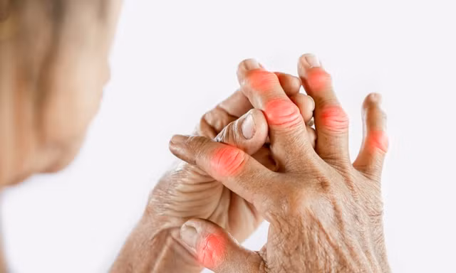 Pháp – Việt phối hợp tìm giải pháp trị dứt điểm bệnh gút