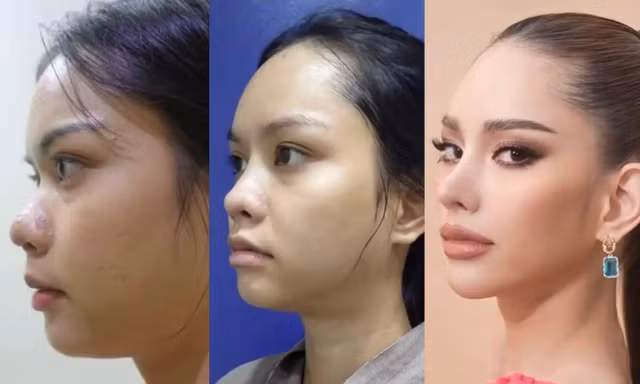 Tân Hoa hậu Hoàn vũ Thái Lan 2022 lộ ảnh trước khi phẫu thuật thẩm mỹ