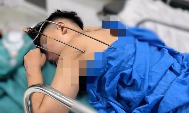 Nam sinh 17 tuổi bị cây đinh ba đâm xuyên tim phổi thoát chết kì diệu 