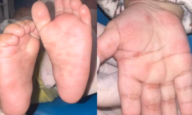 Bé 4 tháng tuổi bị bệnh giang mai bẩm sinh