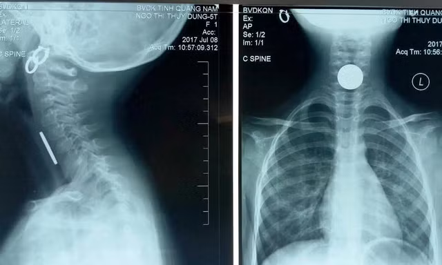 Gắp thành công đồng xu 500 đồng mắc kẹt trong thực quản bé gái.