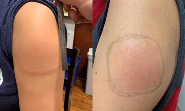 Tại sao nhiều người xuất hiện triệu chứng 'cánh tay COVID' sau khi tiêm vaccine?