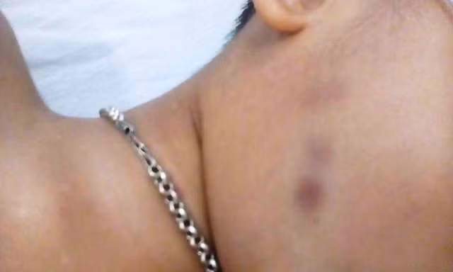 Sức khỏe của cháu L. được tiên lượng rất xấu