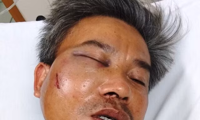 Nạn nhân Lê Song Toàn bị gãy hàm, vỡ xoang... phải can thiệp phẫu thuật để trị thương.