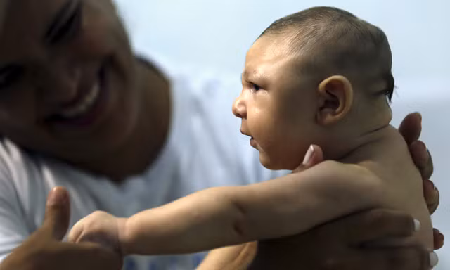 Bé Juan Pedro mắc chứng đầu nhỏ vì Zika ở Recife, Brazil