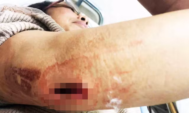 Nạn nhân bị thương, phải vào bệnh viện cấp cứu