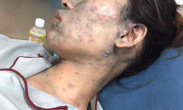 Nhiều người lớn mắc thủy đậu bị biến chứng nặng 