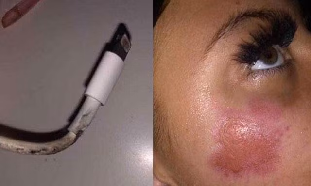 Thiếu nữ bị bỏng mặt vì iPhone bất ngờ phát nổ khi cắm sạc qua đêm