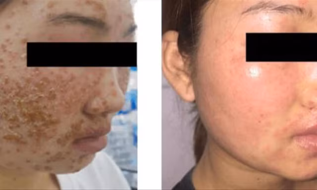 Bệnh nhân trước và sau 5 ngày điều trị 