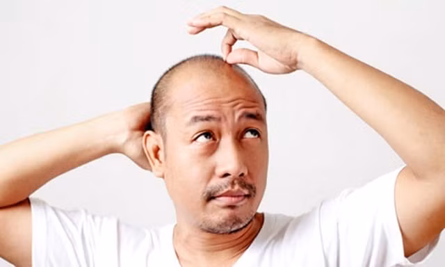 Những bệnh đàn ông hói đầu dễ mắc phải