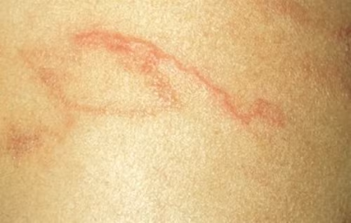 Những nốt sẩn ngoằn ngoèo dưới da ở bệnh nhân nhiễm giun lươn mạn. Ảnh: T.H. 