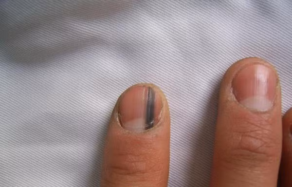 Phát hiện dấu hiệu ung thư tiềm ẩn qua móng tay, tóc, răng...