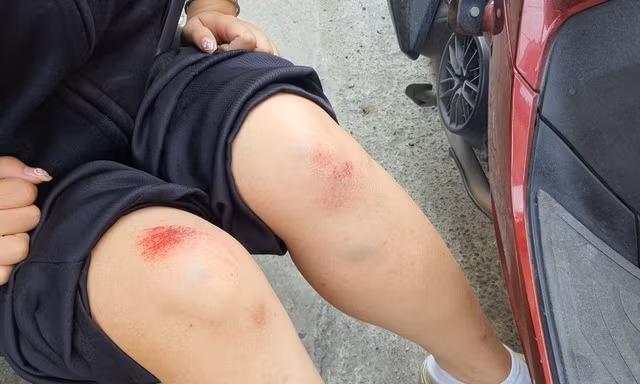 Giữa ban ngày, cô gái trẻ bị giật túi xách ngã nhào xuống đường