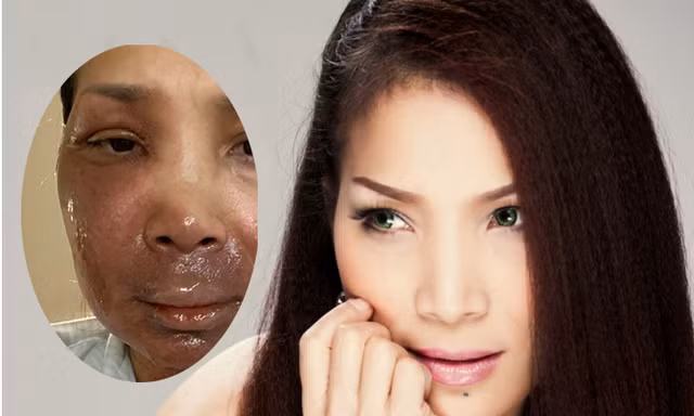 Hồng Ngọc lần đầu công khai hình ảnh khuôn mặt bị bỏng đến 2/3 và chia sẻ điều xúc động