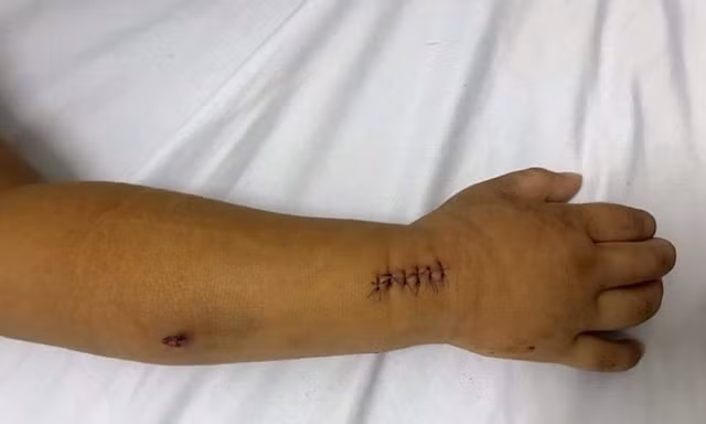 Hà Nội: Đang chơi với bạn, bé 5 tuổi vô tình trúng đạn súng hơi 