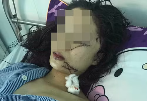 Nạn nhân Q. đang điều trị tại bệnh viên với nhiều vết thương ở vùng mặt 