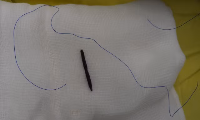 Sơ ý khi cắt cỏ, người đàn ông bị đoạn dây kẽm gai xuyên từ bụng lên tim